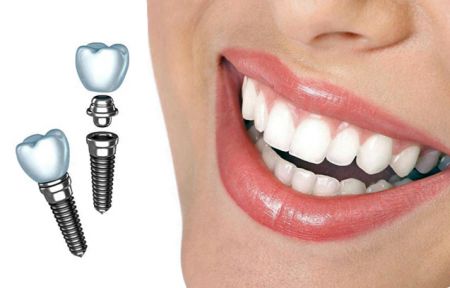 Имплантация зубов в Твери